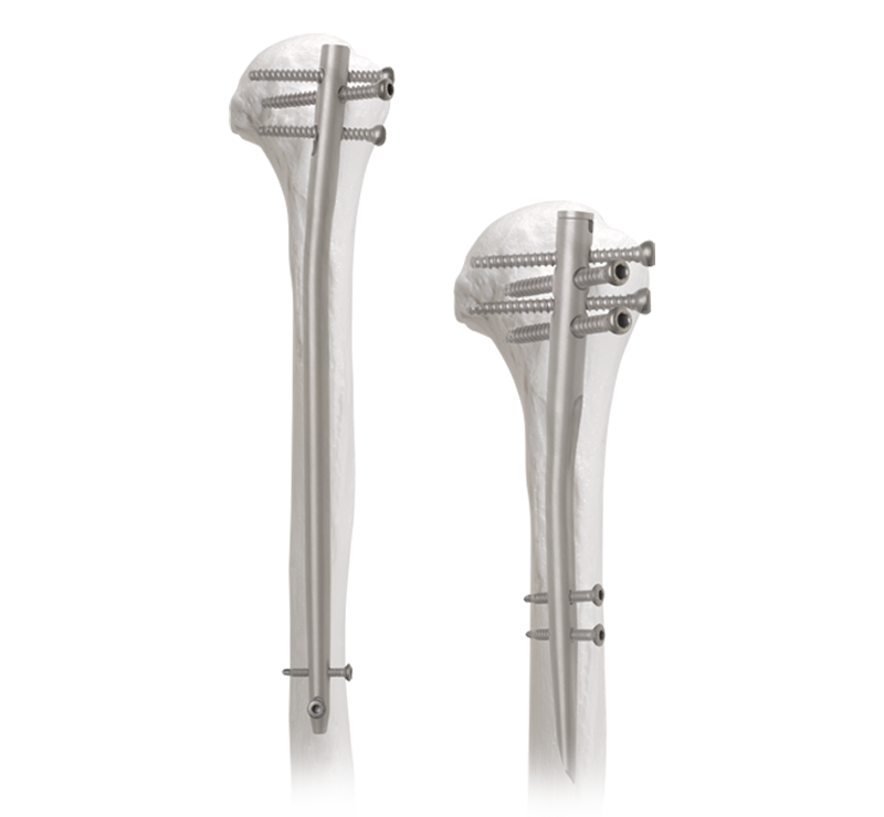 Clou intramédullaire humérus : une solution efficace pour traiter les fractures humérales