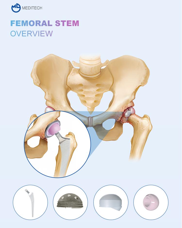 股骨柄使用图 股骨柄使用图