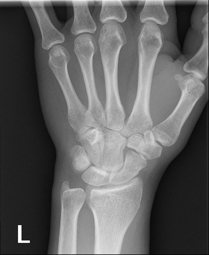 Nouvelles techniques de fixation par plaque palmaire des fractures distales du radius​​