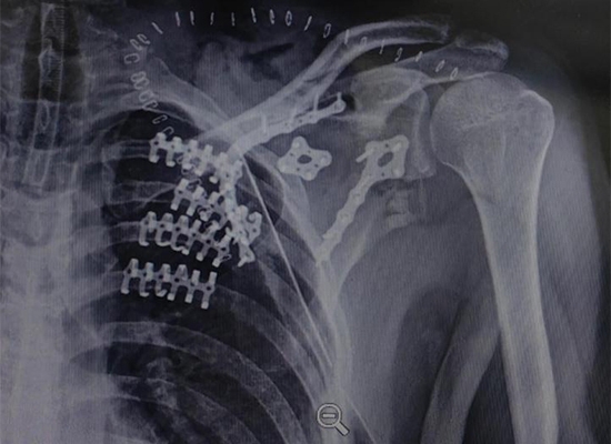 czmeditech-mexique-poitrine-mur-stabilisation-postop&eacute;ratoire-xray-01