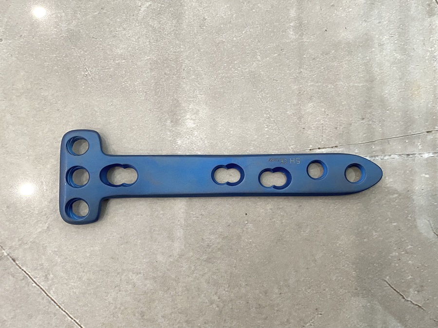 Plaque de verrouillage du contrefort de la t&ecirc;te tibiale lat&eacute;rale