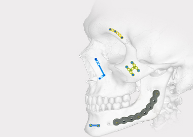 Système de placage de mandibule