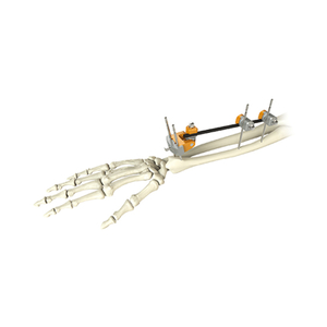 Rayon distal Fixateur externe