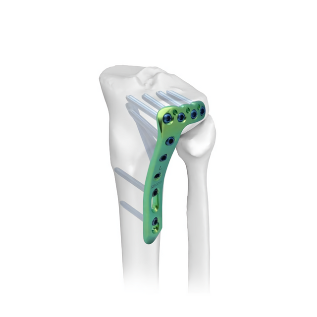 Plaque de verrouillage pour tibia latéral proximal-II