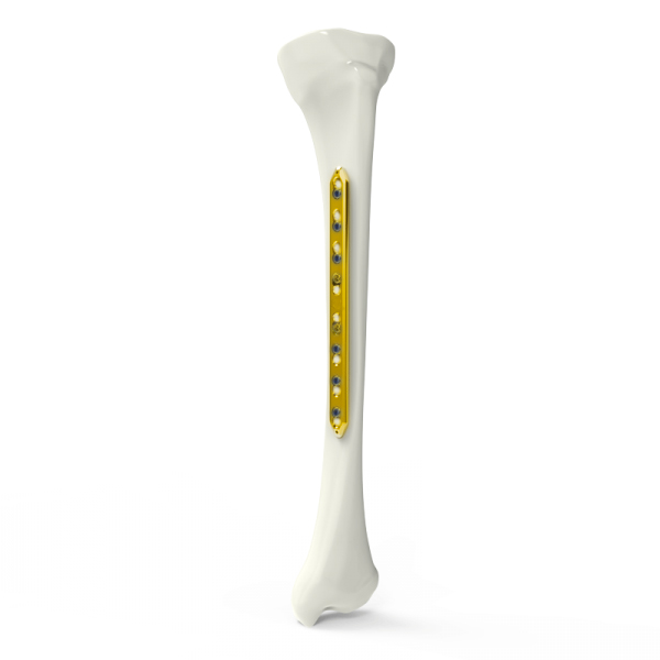 Plaque de verrouillage du tibia étroite