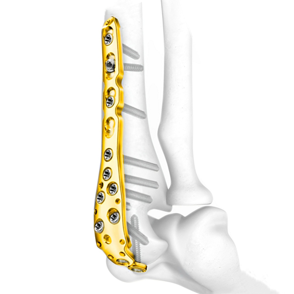 Plaque de verrouillage Olécrane