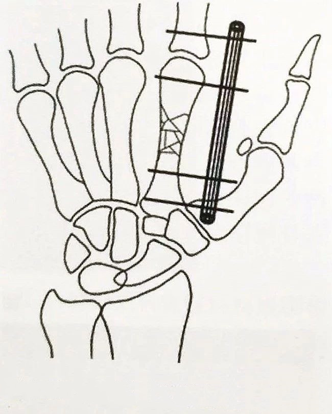 Support de fixation externe