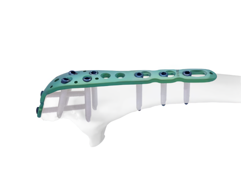 Plaque de verrouillage Olecranon : restauration de la stabilité et de la fonction du coude