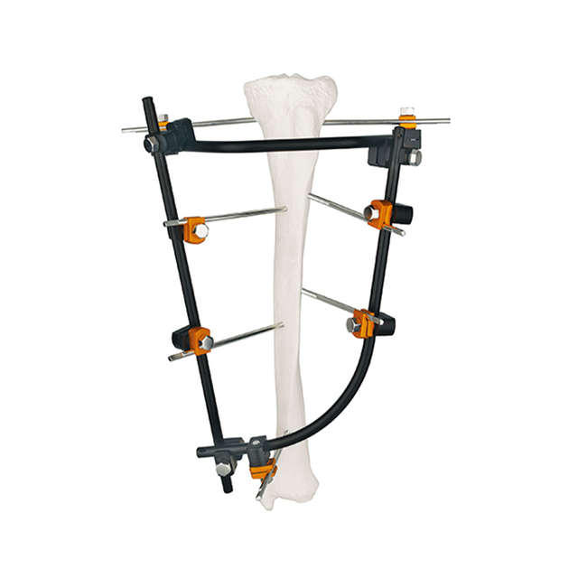 Fixateur externe côté articulation tibiale