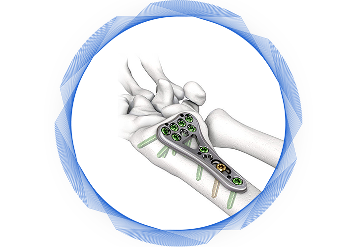 Plaque de verrouillage