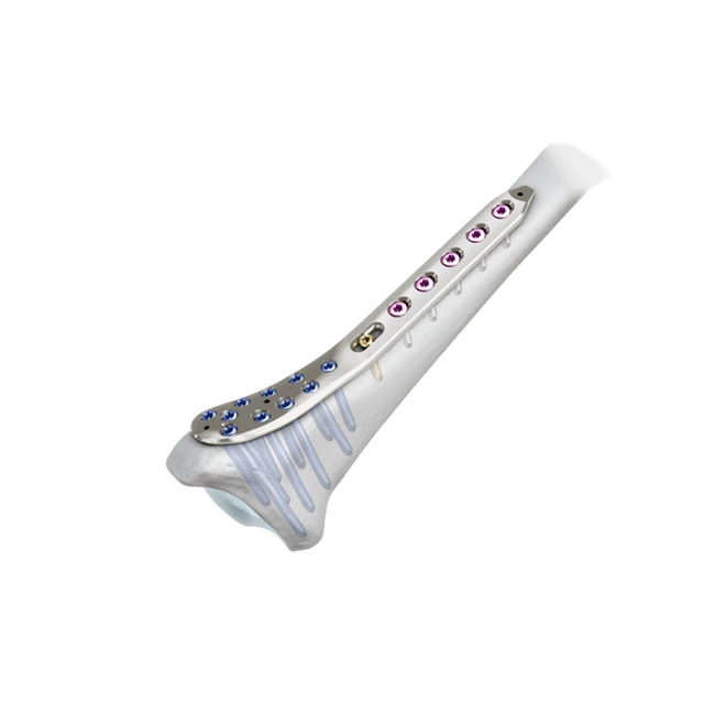 Plaque de verrouillage tibiale médiale distale-II