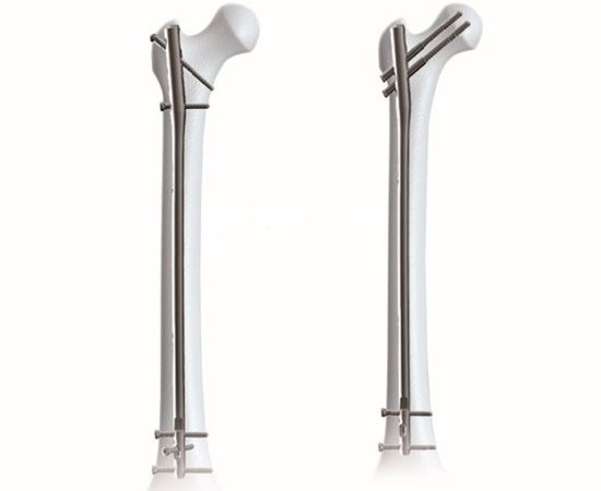 Clou intramédullaire fémoral Expert