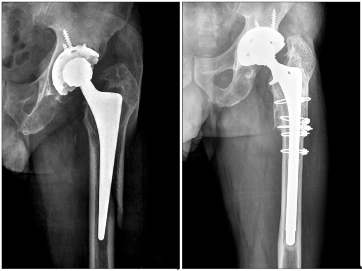 Comment traite-t-on une fracture périprothétique ?