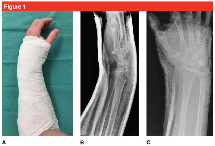 Fracture distale du radius