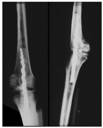 Les anciens &Eacute;gyptiens ont d'abord utilis&eacute; un dispositif intram&eacute;dullaire semblable &agrave; un clou.Il &eacute;tait peu probable que les soins chirurgicaux complexes pour les fractures aient exist&eacute; il y a tant d'ann&eacute;es.Ce qui est certain, cependant, c'est que les anciens Egyptiens avaient de grandes techniques d'embaumement issues de leur croyance en la r&eacute;surrection du corps dans l'au-del&agrave;.Ce fut le cas de la momie appel&eacute;e Usermontu trouv&eacute;e dans la tombe de Toutankhamon, o&ugrave; un clou filet&eacute; &eacute;tait ins&eacute;r&eacute; entre le f&eacute;mur et le tibia pour stabiliser l'articulation du genou (comme sur la figure 2).Les arch&eacute;ologues pensent que la momie &agrave; l'int&eacute;rieur du sarcophage n'&eacute;tait pas Usermontu lui-m&ecirc;me, mais quelqu'un d'autre qui a &eacute;t&eacute; remplac&eacute; par d'anciens voleurs de tombes en 600 avant notre &egrave;re.2000 ans plus tard, Bernardino de Sahagun, un anthropologue de l'exp&eacute;dition Hernando Cortes, rapporte la premi&egrave;re utilisation de l'enclouage centrom&eacute;dullaire chez un patient vivant au Mexique.En 1524, il a vu un chirurgien osseux azt&egrave;que (nomm&eacute; 'Tezalo') effectuer une ost&eacute;otomie &agrave; l'aide d'un couteau en obsidienne, puis ins&eacute;rer une tige de r&eacute;sine dans la cavit&eacute; m&eacute;dullaire pour stabiliser la fracture.En raison du manque de techniques chirurgicales ad&eacute;quates et d'antiseptiques, ces proc&eacute;dures avaient un taux &eacute;lev&eacute; de complications et un taux de mortalit&eacute; &eacute;lev&eacute;.