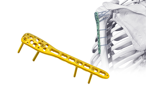 Nail tibial distal: une percée dans le traitement des fractures tibiales distales