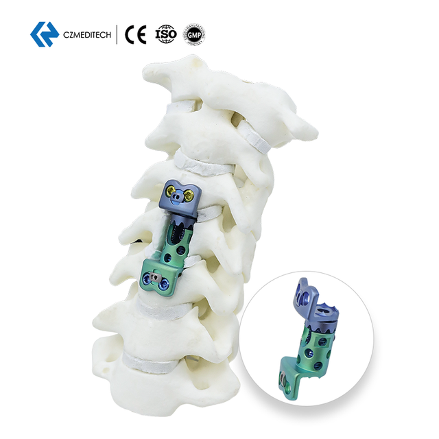 Cage en maille en titane extensible cervical