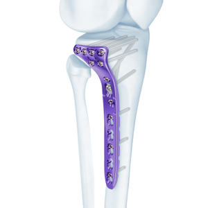 VA Plaque de verrouillage du tibia proximal
