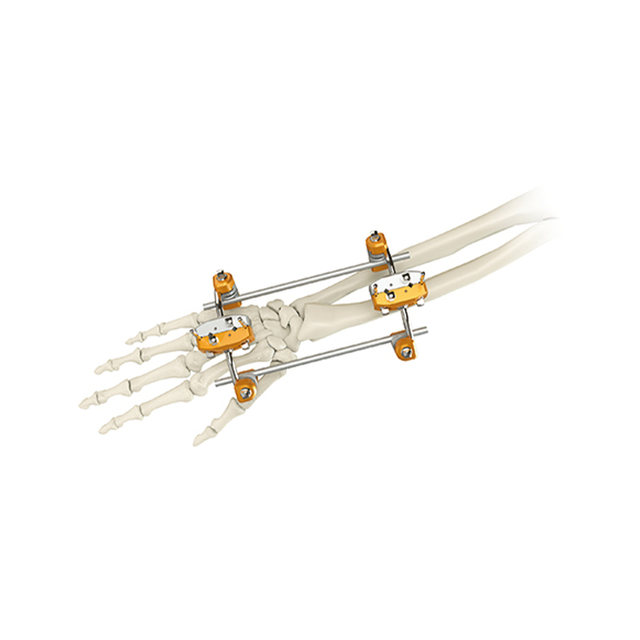 Fixateur externe Uina et rayon