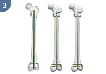 Expert R/Afn.Clou f&eacute;moral r&eacute;trograde/ant&eacute;rograde