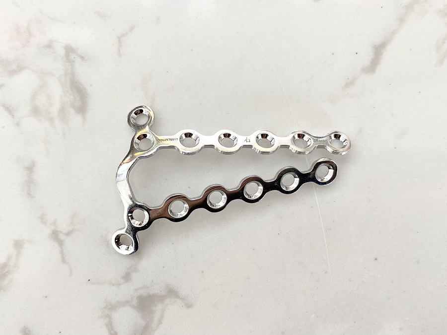 Plaque arri&egrave;re du radius distal