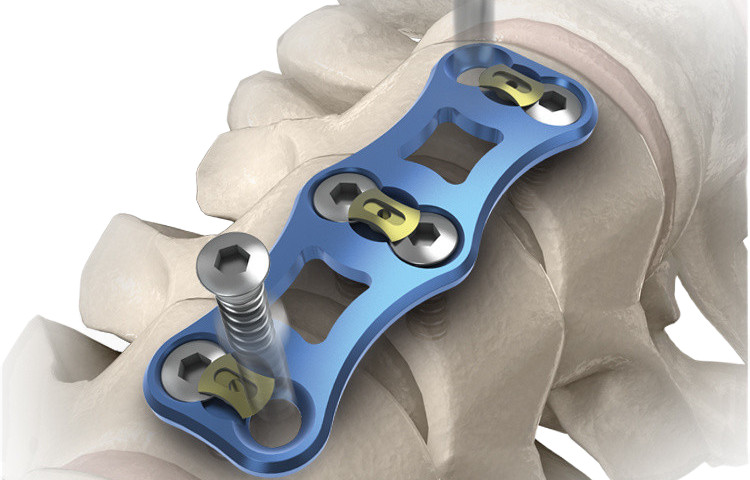 Orthopedic-Implant-Cervical-Vertebra-Anterior-Titanium-Plates-III_副本_副本