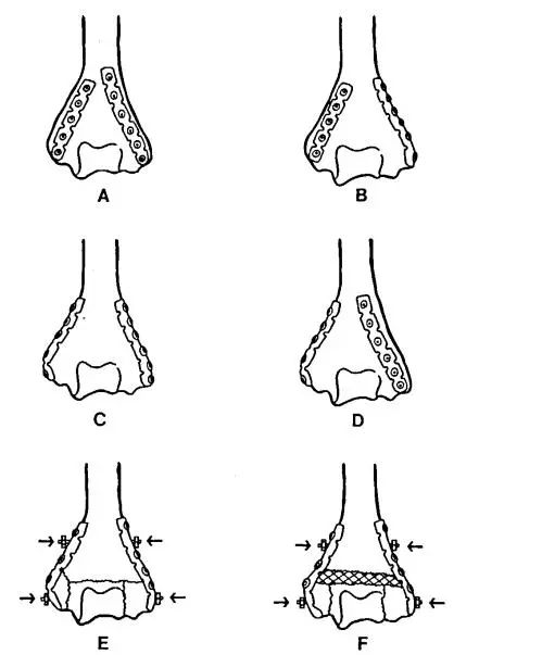 Fractures distales de l'hum&eacute;rus