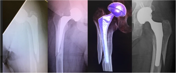 Mode de rupture de retournement invers&eacute;.