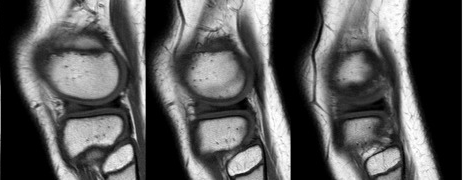 m&eacute;nisque lat&eacute;ral disco&iuml;de1