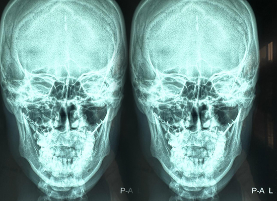 r&eacute;sultat-postop&eacute;ratoire-fixation-maxillo-faciale-t&ecirc;te-hum&eacute;rale