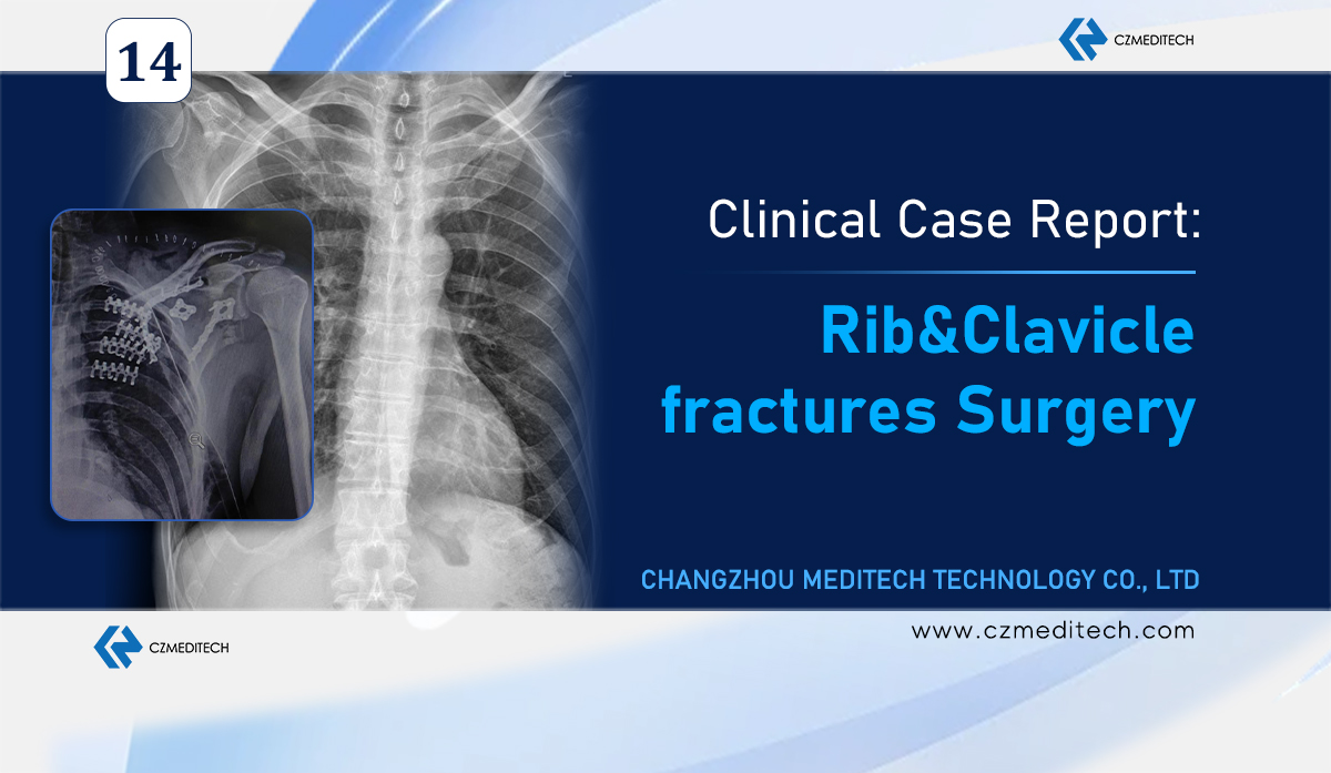 Étude de cas : Fixation d'une fracture des côtes et de la clavicule avec stabilisation de la paroi thoracique au Mexique