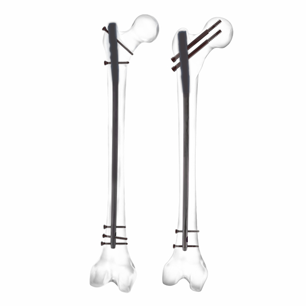 Clou fémoral expert