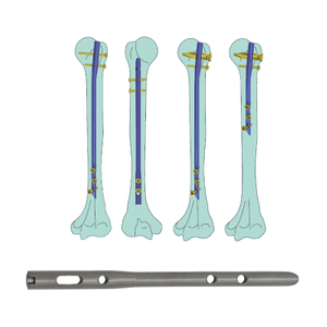 Ongle intramédullaire huméral (type de lame)