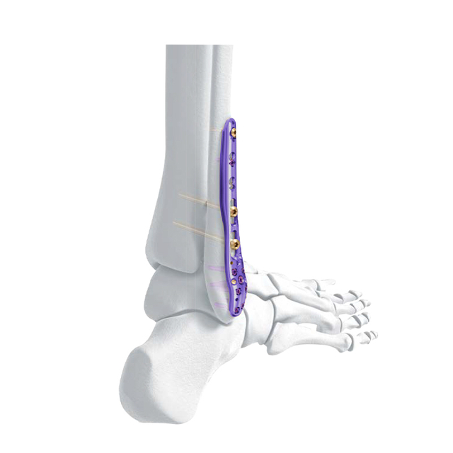 Plaque de verrouillage fibulaire latérale distale