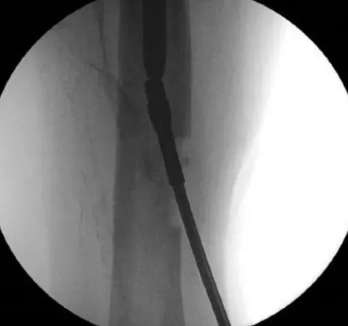 retirer un clou intram&eacute;dullaire solide cass&eacute;