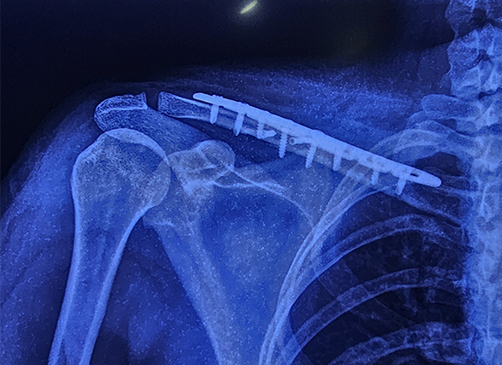 postop&eacute;ratoire-clavicule-verrouillage-plaque-fixation-czmeditech