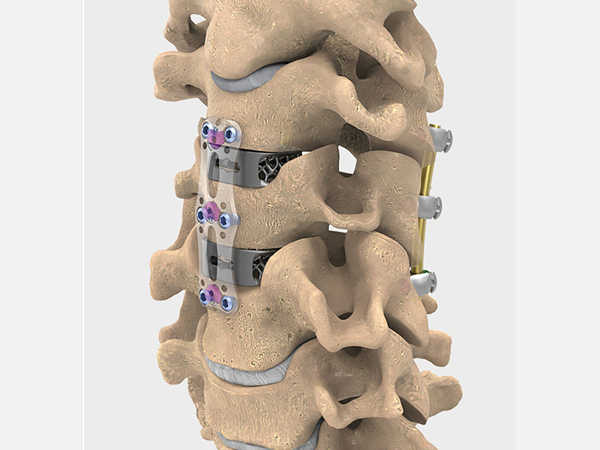 Que sont les implants cervicaux ?