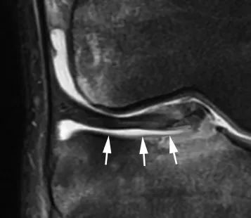 m&eacute;nisque flottant