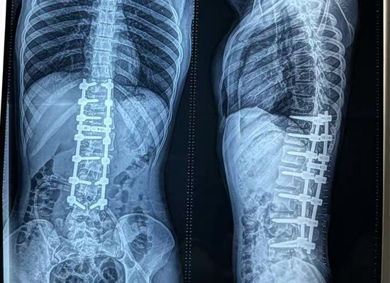 Radiographie postop&eacute;ratoire montrant un alignement corrig&eacute; de la colonne vert&eacute;brale apr&egrave;s une chirurgie de la scoliose au Bangladesh-czmeditech