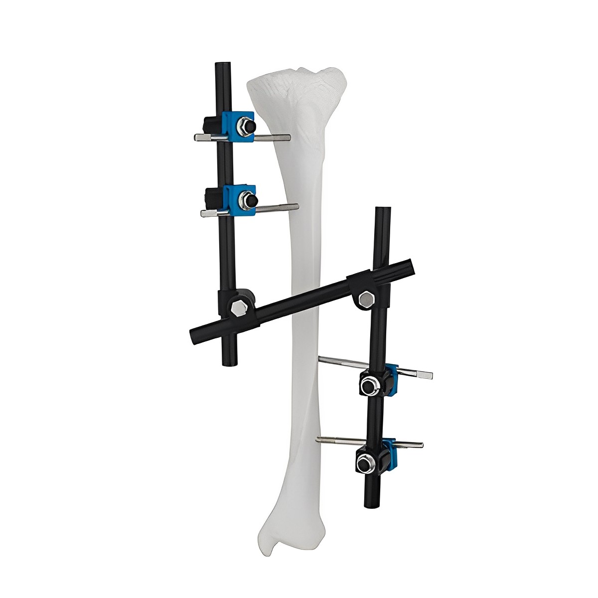 Fixateur externe pour gros fragments