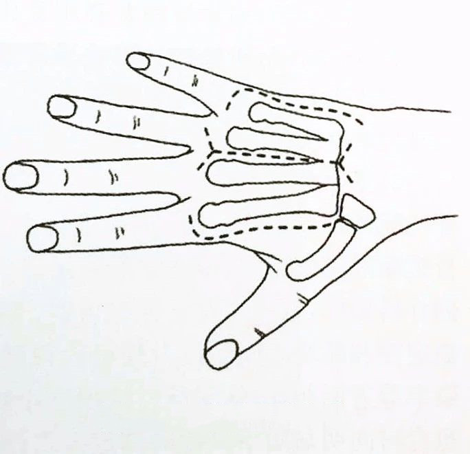 Chirurgie de la paume