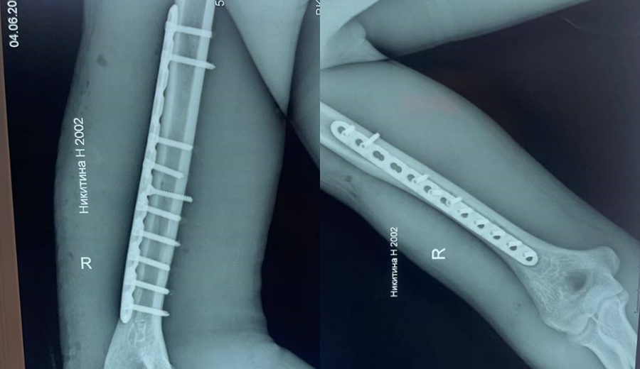 Radiographie postop&eacute;ratoire de la plaque de verrouillage hum&eacute;rale droite