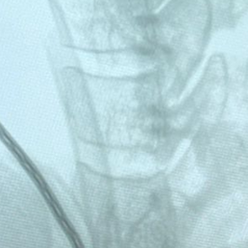 Radiographie pr&eacute;op&eacute;ratoire du rachis cervical lat&eacute;ral
