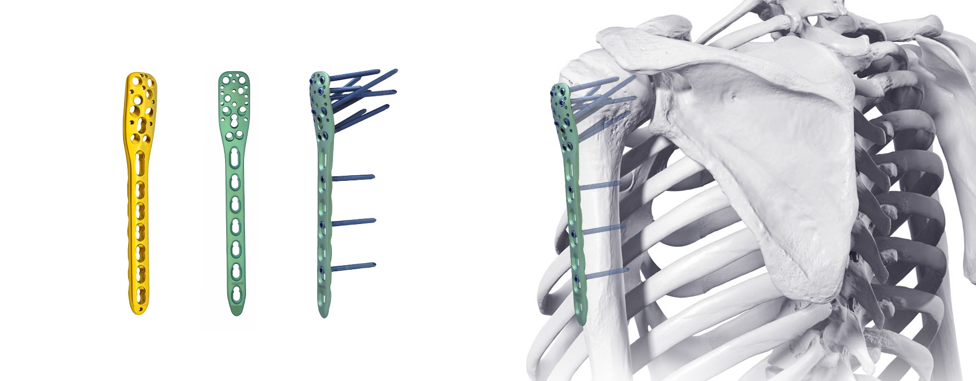 application chirurgicale de fixation par plaque de verrouillage de l