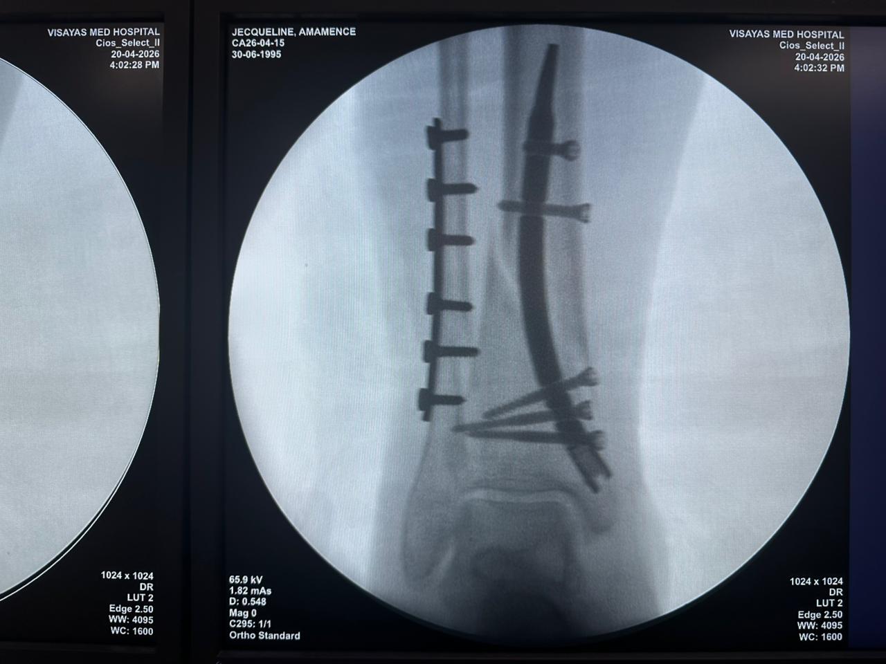 Clou-tibial-distal-fluoroscopie-perop&eacute;ratoire-CZMEDITECH (4)