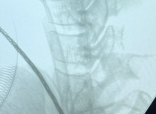 Radiographie cervicale lat&eacute;rale pr&eacute;op&eacute;ratoire montrant le niveau cible pour la mise en place de la cage mexicaine Uni-C