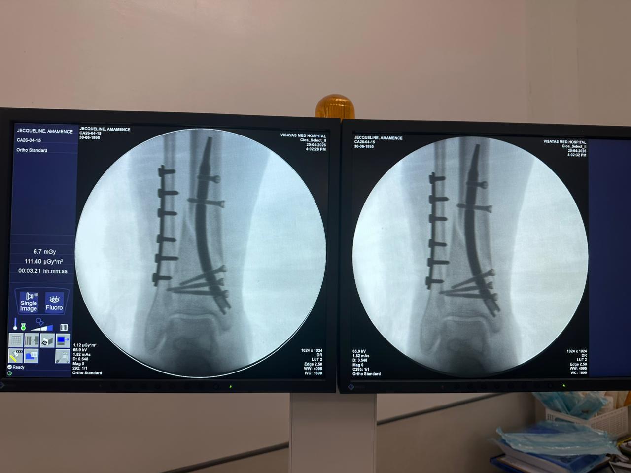 cas-de-fixation-tibia-p&eacute;ron&eacute;-distal-CZMEDITECH