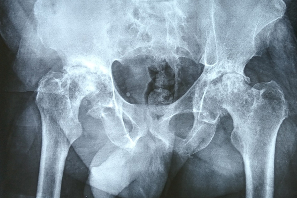 Radiographie pelvienne pr&eacute;op&eacute;ratoire avant arthroplastie totale de hanche droite 