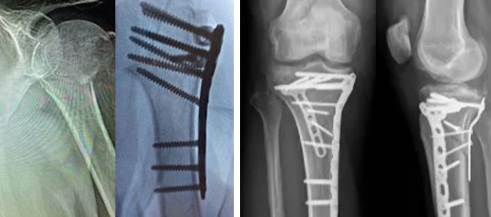Chirurgie orthop&eacute;dique de fixation par plaque de verrouillage de l