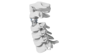 Cage lombaire extensible Stryker